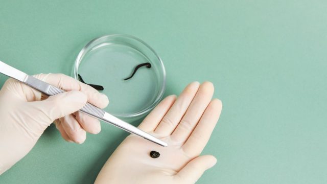 Czy hirudoterapia może pomóc w leczeniu trądziku pospolitego?